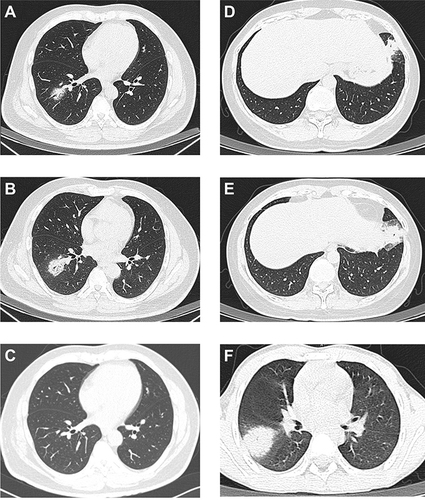 Figure 1 Chest CT images of Chlamydia psittaci pneumonia. (A–C) Chest computed tomography of patient 1 prior to treatment, after administration of empirical moxifloxacin and after administration of doxycycline. (D and E) Chest computed tomography of patient 2 before treatment and after administration of empirical moxifloxacin. (F) Chest computed tomography of patient 3 before treatment.