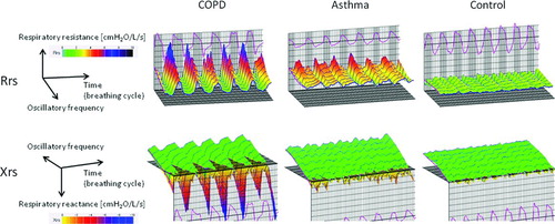 Figure 1  Colored 3 dimensional images of respiratory system resistance (Rrs) and reactance (Xrs) in each representative subject. Exp, expiratory; insp, inspiratory.