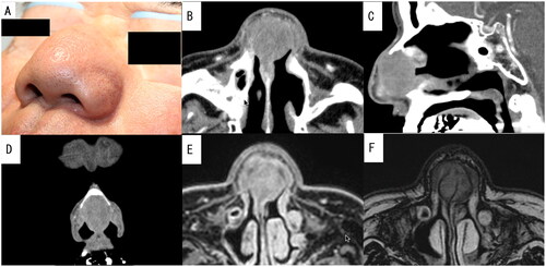 Figure 3. Preoperative photograph of the patient and enhanced computed tomography (CT) and plain magnetic resonance imaging (MRI) images of the nasal sinus of case 2. A well-defined mass measuring 29 × 28 mm was visualized using contrast-enhanced CT without any contrast effect. It had replaced the nasal septal cartilage. Additionally, both T1-weighted and T2-weighted MRI showed a mass with low to normal signal intensity. (A) Preoperative photograph showing symmetrical swelling from the nasal dorsum to the nasal alae. (B) Axial CT image. (C) Sagittal CT image. (D) Coronal CT image. (E) Axial MRI T1-weighted image. (F) Axial MRI T2-weighted image.