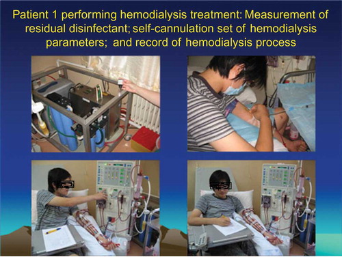 Figure 2.  Patient 1 performing HD treatment in a hospital.
