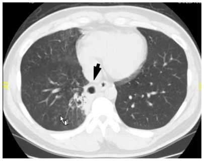 Figure 3 Chest computed tomography taken 13 days after presentation showing the disappearance of the lung ball (arrow) and the presence of a cavitary lesion in the right lower lung field.