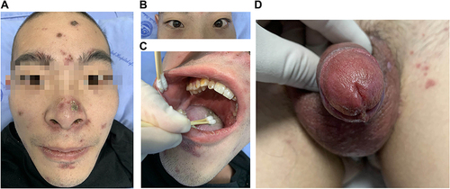 Figure 2 Clinical manifestations after 3 weeks systemic therapy. (A) The facial rash apparently subsided. (B) Edema and congestion disappeared in both eyes. (C) Oral ulcer healing. (D) The urethritis disappears, the redness of the genitals subsides, and the ulcer heals.