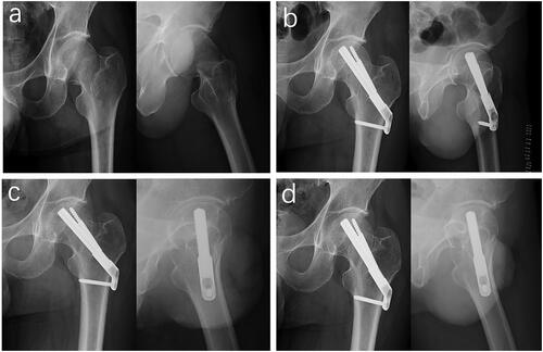 Figure 2. Preoperative anteroposterior and lateral hip X-rays of a 53-year-old male patient with Left femoral neck fracture treated with FNS. (a) Preoperatively. (b) Postoperatively after 2 days. (c) Postoperatively after 6 months. (d) Postoperatively after 1 year.