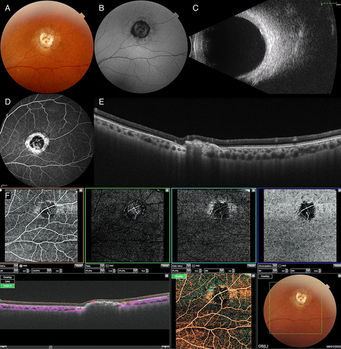 Figure 2 Multimodal imaging in sclerochoroidal calcification (SCC). (A) Color fundus photograph shows the SCC lesion in the superotemporal periphery. (B) Fundus autofluorescence demonstrates mixed hypoautofluorescence and hyperautofluorescence. (C) B-mode ultrasonogram shows an acoustically solid lesion. (D) Fluorescein angiography shows central hyperfluorescent calcific deposits, peripheral window defect, and chorioretinal shunt vessel. (E) Swept source optical coherence tomography shows the SCC lesion in rocky configuration and disrupted outer retinal layers. (F) Swept source optical coherence tomography angiography demonstrates mixed hypo- and hyperreflectivity in the superficial and deep retinal slabs and hyporeflectivity in the outer retinal and choriocapillaris slabs which is probably due to shadowing from calcium. Also, a chorioretinal shunt vessel is visible in all slabs.