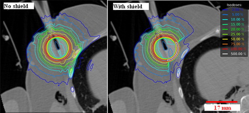 Figure 1. Comparison of the dose distribution of an IORT treatment, respectively without shielding on the left and with shielding placed on the pectoral muscle on the right.