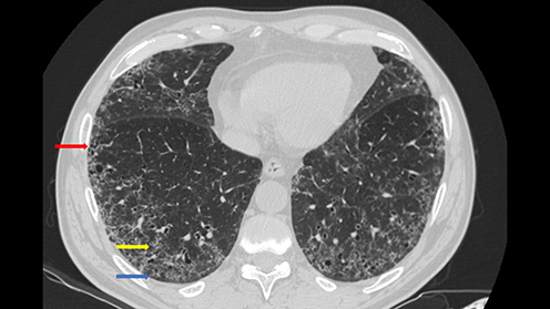 Figure 1 Fibrotic Nonspecific Interstitial Pneumonia in a patient with a longstanding Mixed Connective Tissue Disease. The pattern is characterized by diffuse Ground Glass Opacities (yellow arrow), subpleural sparing (blue arrow), and presence of traction bronchiectasis (red arrow).