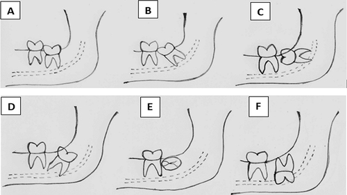 Figure 4 Winters classification. (A) Vertical impaction. (B) Mesioangular impaction. (C) Horizontal impaction. (D) Distoangular impaction. (E) Bucco-lingual impaction. (F) Others.