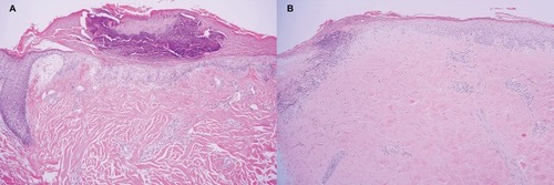 Figure 2 (A) Histopathology from case 1 showed hyperkeratotic epidermal atrophy, vacuolar alteration of basal keratinocytes, marked papillary edema with extravasated red blood cells, and telangiectasia (H&E, 100x). (B) Histopathology from case 3 showed wedge-shaped infarct in papillary dermis with sparse lymphoplasmacytic infiltrate and vacuolar alteration of basal cell layer. Homogenized eosinophilic altered collagen bundles within the entire dermis (H&E, 100x).