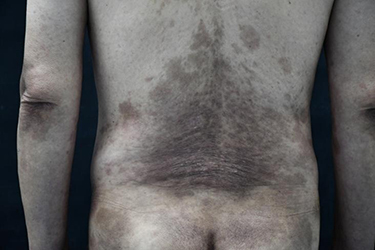 Figure 2 Erythematous scales on the buttocks and back basically subsided, leaving hazel pigmentation.