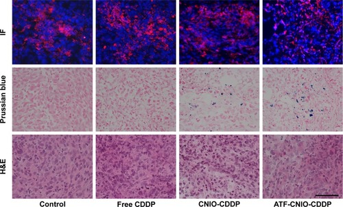 Figure 4 Histological validation of nanoparticle accumulation in orthotopic MIA PaCa-2 tumors with IF labeling of uPAR, Prussian blue for iron, and H&E staining.Notes: Heterogeneous expression of uPAR (in red) was detected in MIA PaCa-2 tumors, where nuclei were stained with DAPI (in blue). Prussian blue staining revealed the area accumulated with targeted ATF-CNIO-CDDP overlapped with the area showing uPAR overexpression. The scale bar is 50 μm.Abbreviations: ATF, amino-terminal fragment; CDDP, cisplatin; CNIO, milk protein (casein)-coated magnetic iron oxide; H&E, hemtoxylin and eosin; IF, immunofluorescence; uPAR, urokinase plasminogen activator receptor; DAPI, 4′,6-diamidino-2-phenylindole.