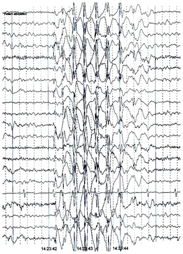 Figure 5 Pattern-induced generalized epileptiform discharge.