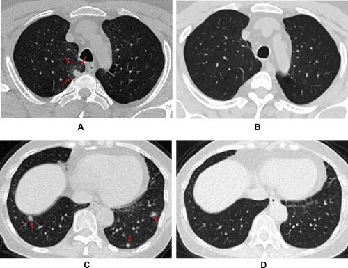 Figure 1 Absorbable PSNs on CT images. (A) Axial CT image in a 50-year-old male shows a round, homogeneous, and well-defined PSN that has a halo sign (arrows) and abuts pleura with a broad basement located in the right upper lobe. (B) It had disappeared at 1-month follow-up. (C) Axial CT image in a 65-year-old female shows multiple, round or oval, ill-defined PSNs (arrow) located in the bilateral lower lobes. (D) They had disappeared at 10-month follow-up.