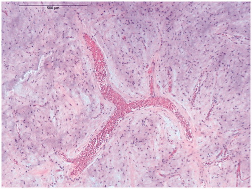 Figure 1. Micrograph demonstrating the delicate branching capillary network which is characteristic of myxoid liposarcoma (hematoxylin-eosin stain).