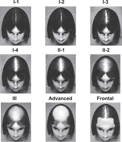 Figure 3 Savin Scale (CitationSavin 1994).The Savin scale measures overall thinning of the crown scalp, and consists of 8 crown density images reflecting a range from no hair loss to severe hair loss (Stages I-1, I-2, I-3, I-4, II-1, II-2, III, advanced). The ninth and final image in the scale demonstrates frontal anterior recession.