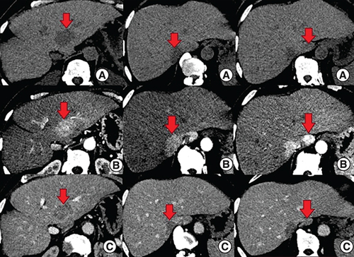 Figure 1. Abdominal CT – axial sections showing the hepatic lesions (red arrows).(A) The lesions are spontaneously hypodense. (B) After injection of contrast product, the lesions are intensely enhancing in the arterial phase. (C) Contrast product wash out in the portal phase.