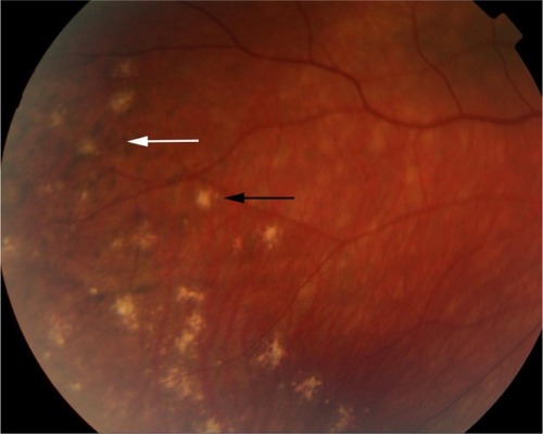 Figure 5 Color retinal photograph displaying sunset glow fundus with a numerous small choroidal depigmented atrophic lesions (black arrow) and hyperpigmented lesions (white arrow) in the retinal periphery during the convalescent phase of VKHD.
