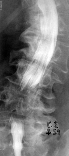 Figure 2. Preoperative evaluation using myelography in a case with degenerative scoliosis.