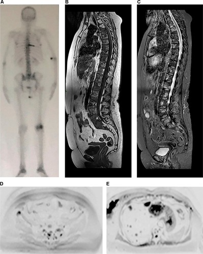 Figure 5 A 64-year-old female patient with a diagnosis of breast cancer, undergoing hormone therapy and with a complaint of bone pain.Notes: Bone scintigraphy (A) shows increased uptake of technetium-99m in some vertebral bodies and in a left costal arch, which was suspicious for metastatic disease, as well as increased uptake in left femoral condyles, probably due to gonarthrosis. Whole-body MR performed at the same time shows secondary cancer diffusely distributed in the vertebral column in sagittal T1 and STIR sequences (B and C), more clearly defined than those shown on scintigraphy, as well as metastatic focus in the right ilium, which is observed in diffusion-weighted sequence (b800) in inverted grayscale in the axial plane (D) and was not detected by scintigraphy. Multiple hepatic metastases in the same diffusion-weighted sequence (E) are also observed.Abbreviations: MR, magnetic resonance; STIR, short-tau inversion-recovery.