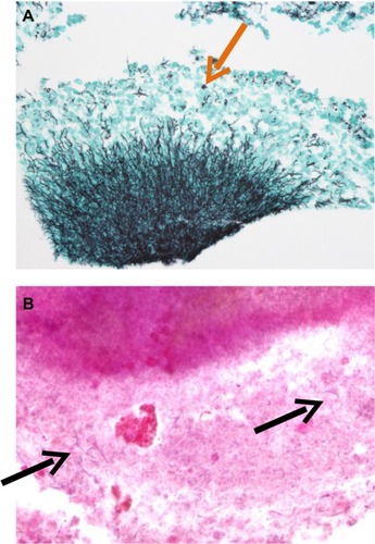 Figure 8 Pathology of a suppurative lesion in a patient with an abdominal wall implant.Notes: Aggregates of Actinomyces spp. and sulfur granules (arrow) after silver staining (A); filamentous bacteria (arrows) after Gram staining (B).