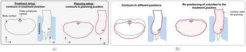 Figure 4. Schematic representation of the body and pubic symphysis contours before and after rigid registration. (a) Contours in treatment position (treatment setup) and planning position (planning setup). (b) Contours overlapped, and after re-positioning the volunteer to the treatment position. The pubic symphysis was used as a reference structure to perform rigid registration.