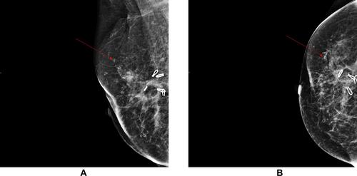 Figure 3 Molybdenum target mammography. (A) MLO position. (B) CC position. As indicated by the red arrow is annular calcification.