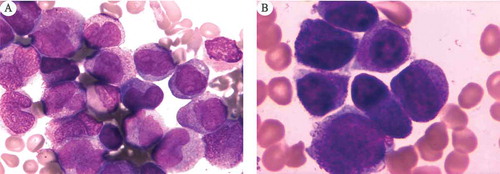 Figure 1. Wright-Giemsa stained bone marrow smears of patients (A) 83% promyelocytes in patient 1; (B) 79% promyelocytes in patient 2.