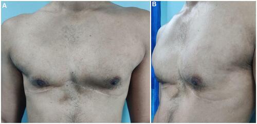 Figure 1 Status post remote pectus excavatum (PEX) repair twenty-two years ago.