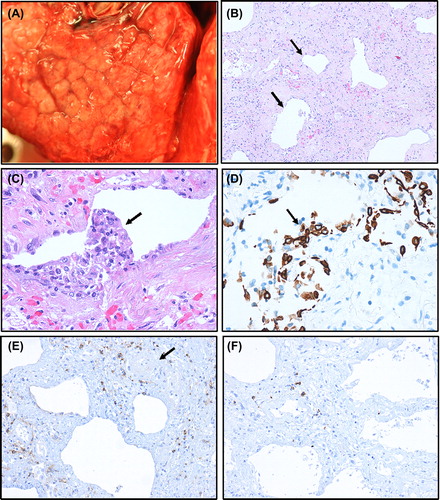 Figure 3. Photomicrographs (A–F) from lung tissue obtained at autopsy. Surface of lung with macroscopic cobblestone appearance evident (A). ‘End-stage’ lung tissue with severe interstitial fibrosis with a few remaining alveolar sacs (arrows) giving a honeycomb pattern (B). Due to postmortem autolysis most alveolar epithelium is detached, but in some alveolar sacs, the epithelium with regenerative atypia has remained as partly detached epithelial clusters (C, arrow), positively stained by the epithelial immunohistochemical marker cytokeratin (PAN) (D, arrow). Only a few scattered, mainly perivascular lymphocytes (arrow at vessel), are observed (E). A slight predominance by CD4 (E) over CD8 (F) T lymphocytes is observed. Magnification: × 100 (B), × 200 (E, F), × 400 (C, D).