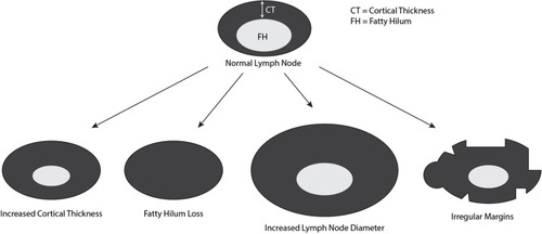 Figure 2 Ultrasound features suggesting metastatic involvement of axillary lymph nodes. Normal lymph nodes have a uniform hypoechoic cortex, central fatty hilum, and smooth margins. Features identified to be predictive of metastatic lymph node disease include increased cortical thickness (OR=3), fatty hilum loss (OR=27), increased diameter, and irregular margins (OR=3). While the features high odds ratios, they are not individually predictive of lymph node metastasis and have poor AUCs.