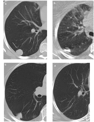 Figure 5. Axial CT images in 62-year-old male patient with metastatic tumour from malignant melanoma in right lower lobe and treated with LITT. (a) Image obtained before ablation showing a nodular metastatic lesion in the right lower lobe with axial diameter of 2 cm. (b) CT image obtained during the process of ablation showing the LITT-applicator within the lesion. (c,d) CT images 6 and 12 months post-LITT ablation, respectively showing atelectatic changes in the ablation zone followed by regression of the scarring changes and resolution of the post-ablation changes.