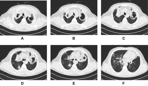 Figure 5 A 51-year-old male patient with MDR-TB. A CT scan revealed whole-lung involvement with multiple thick-walled cavities, proliferative lesions, calcifications, and disseminated lesions along the bronchus in both lungs. Partial atelectasis of the right upper lung lobe was observed (A–F). The predicted value of the model was 0.92419, and the result predicted drug resistance, which was in agreement with DST.