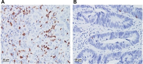 Figure 2 Immunostaining of CD8+ TILs in biopsy samples before CRT showed a high density (A) and a low density (B) of infiltration.