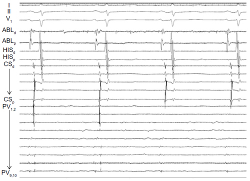 Figure 3 Example of electrical isolation of the pulmonary veins (PVs) as measured by the circular mapping catheter (PV1,2 to PV9,10).