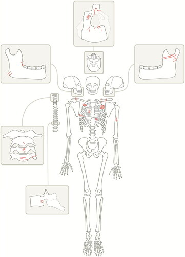 Fig 6 Composite diagram showing distribution of cut marks in the human remains from Wharram Percy. The cervical vertebrae shown inset come from a single individual, and the cut marks on the occipital bone shown inset also occur in one (different) individual. Reproduced with permission from Mays et al Citation2017a.