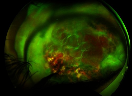 Figure 3 High resolution fundus photo after resolution of Legionella endophthalmitis.