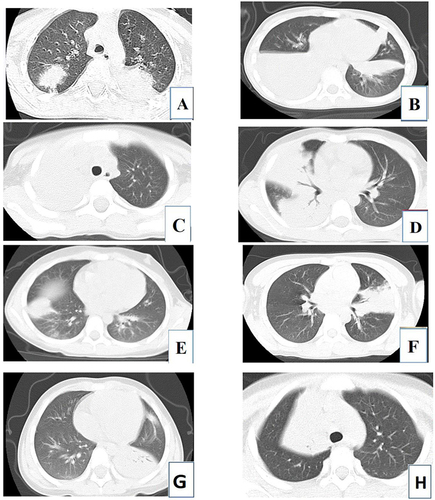 Figure 6 Chest CT changes. (A) Multilobar consolidation (high-density shadow, 3-year-old boy); (B) Consolidation of the right and left upper and lower lobes (5-year-old boy). (C) consolidation of the right upper lobe (high-density shadow, 4-year-old Boy); (D) Consolidation of the right middle lobe (hyperdense opacity, 6-year-old boy) (E) consolidation of the right lower lobe (high-density shadow, 9-year-old boy); (F) Consolidation of the left upper lobe (hyperdense opacity, 7-year-old boy). (G) Left lower lobe consolidation (high density, 5-year-old girl); (H) Atelectasis of the right upper lobe (wedge-shaped soft tissue shadow in a 9-year-old girl).
