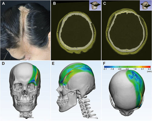 Figure 2 MRI and CT examination of the scalp. (A) En coup de sabre on the scalp. (B and C) MRI and CT fusion images of the scalp at different horizontal levels, fat was marked in yellow pseudo-color base on MRI, bone was marked in white based on CT. (D) Front view of the 3D reconstruction model of the patient’s skull based on CT, the bony change beneath the lesion were shown by color map compared with normal side. (E) Left side view of the 3D model. (F) Top view of the 3D model.