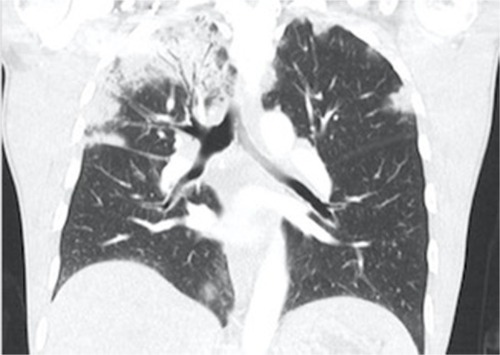 Figure 2 CT coronal view of a patient with CEP demonstrating peripheral consolidation, with alveolar opacities asymmetrically more in the right upper lobe.