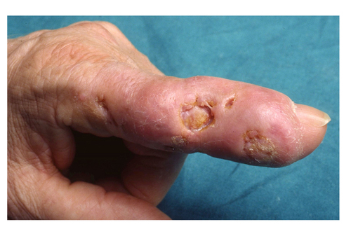 Figure 1 Erythematous swelling, ulcer and crust located at the left index finger.