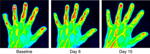 Figure 1 Representative FOI images collected from the target hand of one patient at Baseline, and after 7 (Day 8) and 14 (Day 15) days of using topical diclofenac.