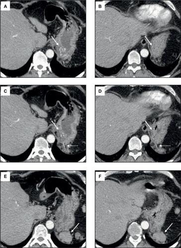 Figure 1 CT images of perigastric splenosis pre- and postembolization of the perfusing network.