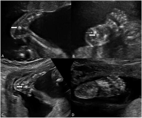 Figure 3. Comparison of normal foot and foot of a fetus with CVT in the location of calcaneus and talus ossification center by prenatal ultrasound. (A, B) The images show abnormal prenatal ultrasound images of the foot location of the calcaneus and talus ossification center with CVT in the sagittal (A) and axial (B) sections. (A) A longitudinal scan of the foot sagittal section shows the calcaneus is valgus, only the talus is shown in the image. (B) A transverse scan of the foot axial section shows the calcaneus and talus are shown on the same section due to the downward movement of the talus. (C, D) The images show normal prenatal ultrasound images of the foot location of calcaneus and talus ossification center in the sagittal section (C) and axial section (D). (C) A longitudinal scan of the foot sagittal section shows the talus is located above the calcaneus. (D) A transverse scan of the foot axial section shows the sole of normal foot only presented soft tissue echoes, due to the presence of normal arch structure (Bold arrow points to the talus, slim arrow points to the calcaneus).