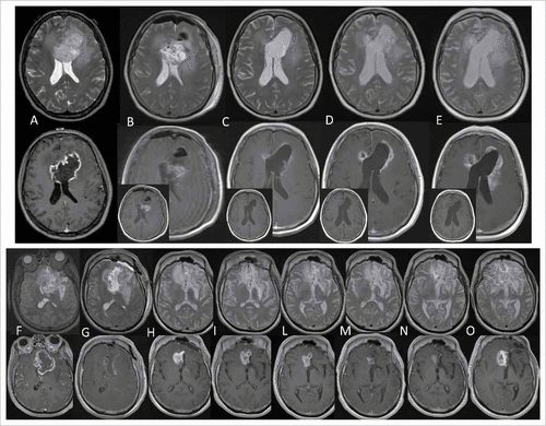 Figure 2. Exemplificative MRI. Patient 17. Top, T2 weighted images (w.i.); bottom, contrast enhanced T1 w.i. (small box, pre-contrast T1 w.i.). (A) Pre-surgery, Dec 5, 2012 (necrotic lesion, GBM). (B). Post-surgery: Dec 6, 2012 (blood presence). (C-E) Immunotherapy: Jan, Mar and May 2013 (progressively enhancing lesion). Patient 12. Top, T2 w.i., bottom, contrast-enhanced T1 w.i. (F) Pre-surgery May 14, 2012 (necrotic lesion, GBM). (G) Post-surgery May 18, 2012 (scarce blood). (H-O) Immunotherapy: H-L (Aug 2012, Nov 2012, Jan 2013) show enhancing lesion. (M) subsequently reduced (M, Mar 2013) suggesting pseudoprogression. (N) subsequent stabilization (May 2014). (O) and disease progression (July 2014).