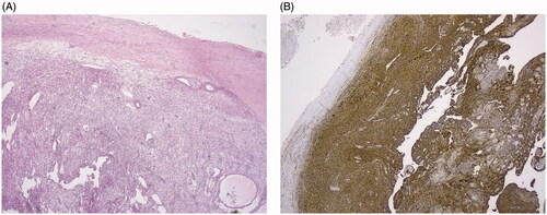 Figure 1. (A) Low power view of a schwannoma, showing an encapsulated spindle cell lesion and vessels with hyaline walls. (B) Presence of diffuse S-100 staining.