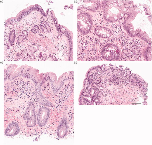 Figure 2. Demonstrating original HE microscopic slides in which primary diagnosis was changed from non-dysplastic metaplasia to low-grade dysplasia (a) after expert GI pathologist re-evaluation. (b) original LGD was downgraded to BE, (c) original LGD did not change and (d) original LGD diagnosis was upgraded to HGD. All images are taken with 20x magnification and 100 µm scalebar is found in image D.