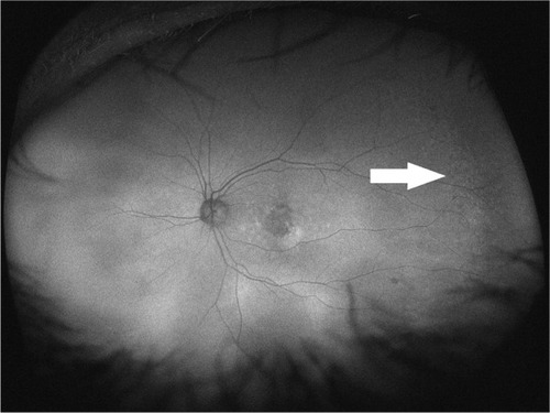 Figure 2 Optos® image of an eye with mottled pattern from a wet age-related macular degeneration patient.