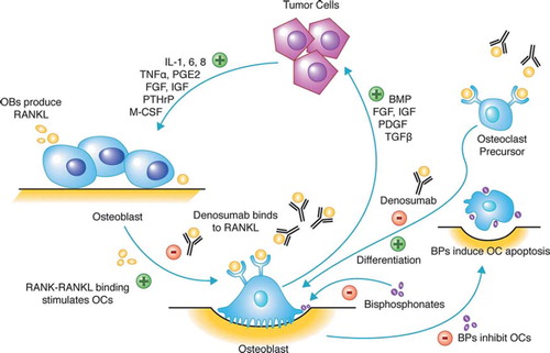 Figure 1. Vicious cycle of osteolytic metastases. Tumor cells secrete cytokines, growth factors, and hormones including parathyroid-hormone related peptide (PTHrP) that stimulate osteoblasts (OB) to secrete RANKL. RANKL activates osteoclasts (OC) to resorb bone, which releases factors: bone morphogenic protein (BMP), fibroblast growth factor (FGF), insulin-like growth factor (IGF), platelet-derived growth factor, and transforming-growth factor-α (TNFα); which promote tumor growth. Both denosumab and bisphosphonates target the bone and interrupt this vicious cycle that supports tumor cells and damages bone. Denosumab binds to RANKL and prevents osteoclast differentiation and activation that therefore halts bone resorption and prevents the release of factors that promote tumor growth. Bisphosphonates inhibit osteoclast activity and induce cellular apoptosis.