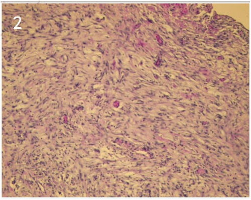 Figure 2. The tissue coming from the PDcatheter lumen showed exudation of sigmoid mesocolon tissue.