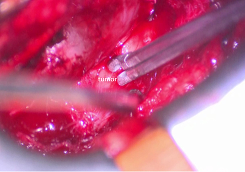 Figure 4 A micro-forceps was used to remove the tumor piecemeal.